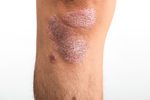 Psoriasis.png#asset:17494
